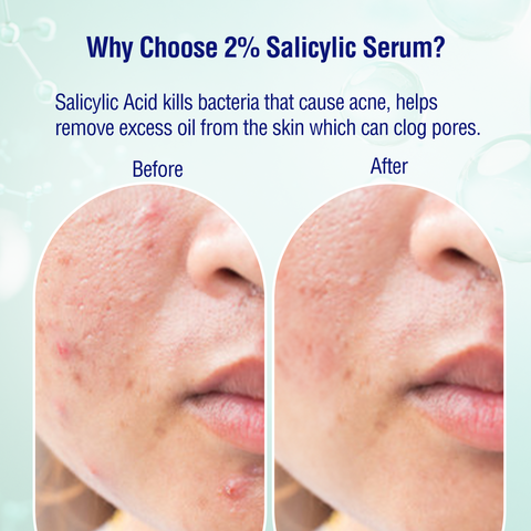 DERMDOC 2% Salicylic Acid Face Serum (30ml) | For Blackheads & Whiteheads | Targets Active Acne | Calms Irritation & Unclogs Pores