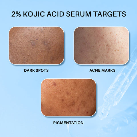 DERMDOC 2% Kojic Acid Face Serum (15 ml) | Brightening & Anti-Pigmentation | Fades Dark Spots, Evens Skin Tone & Enhances Glow