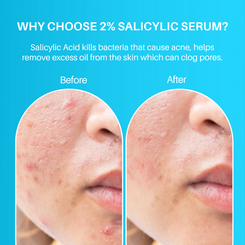 DERMDOC Pore Care Kit | 2% Salicylic Acid Face Serum (15 ml) | 10% Niacinamide Face Serum (15 ml) | Combo of 2