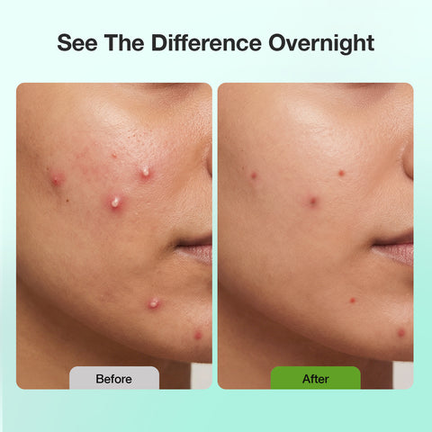 Good Vibes Acne Clear Pimple Patch 36 pcs