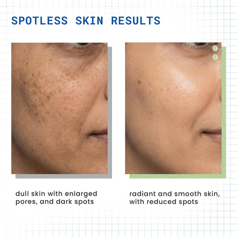 DERMDOC by Purplle 10% Niacinamide Face Serum (30 ml) | Skin Brightening | Niacinamide Face Serum | Niacinamide for Oily Skin