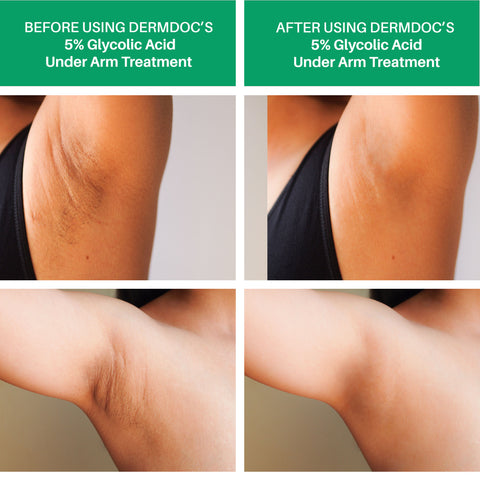 dermdoc-5-percentage-glycolic-acid-under-arm-treatment-100-ml-6